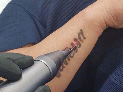 How to Start Laser Tattoo Removal Business