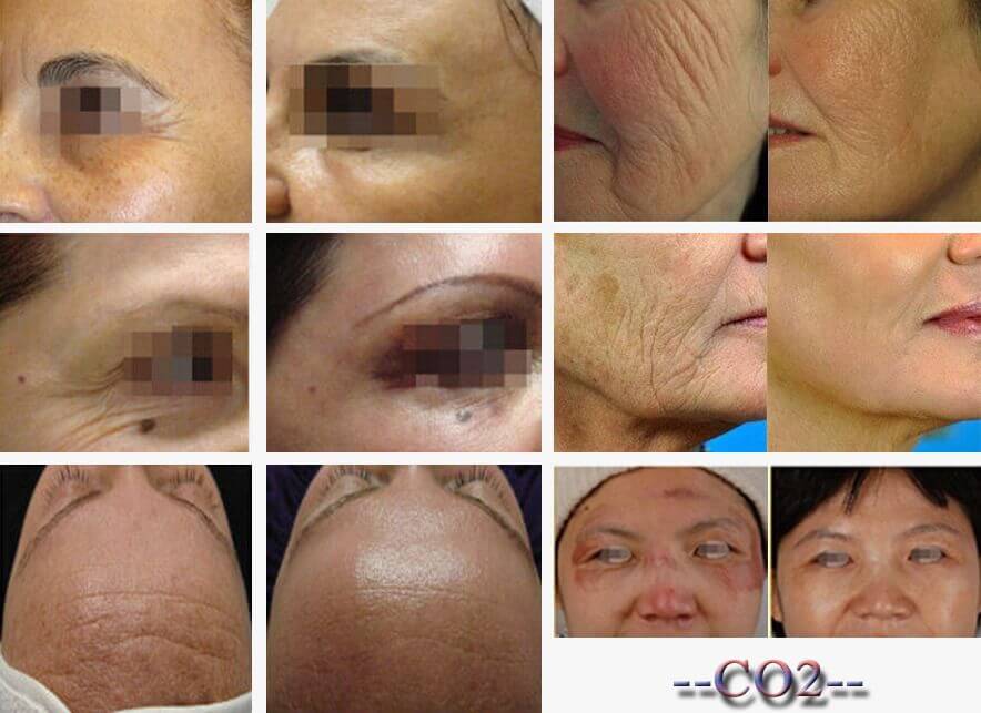 fractional co2 laser scar removal machine