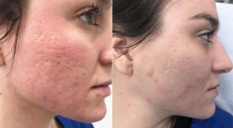 co2 fractional laser acne scars