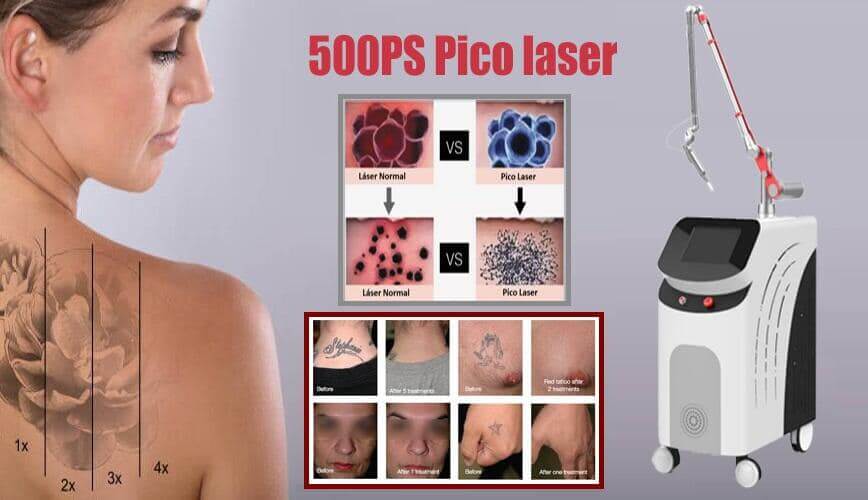 comprar maquina laser para quitar tatuajes