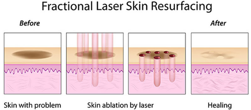 co2 fractional laser machine treatment