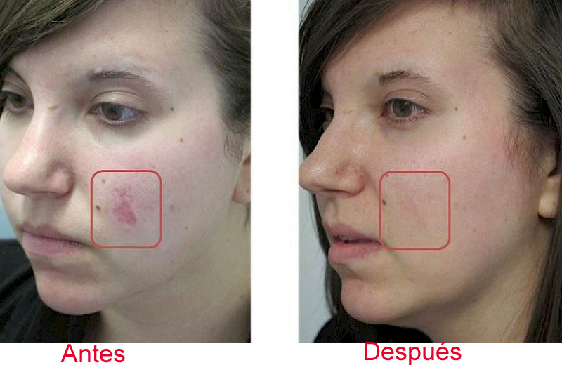 tratamiento facial con láser co2 fraccionado