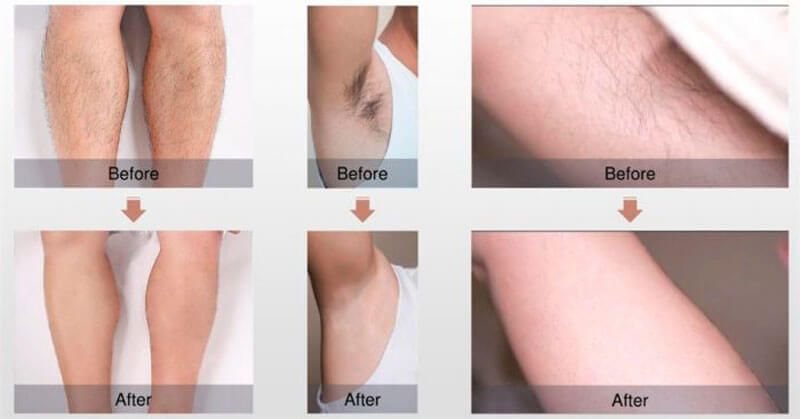 laser hair removal treament