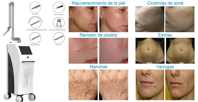 co2 fractional laser skin resurfacing treatment