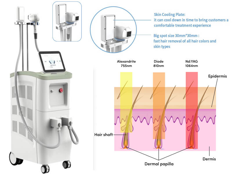 permanent laser hair removal machine