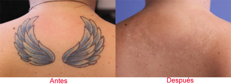 eliminacion de tatuajes con laser picosegundos