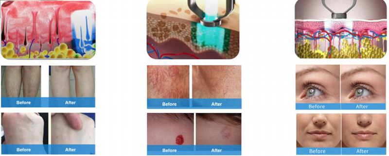 long pulsed nd yag laser hair removal