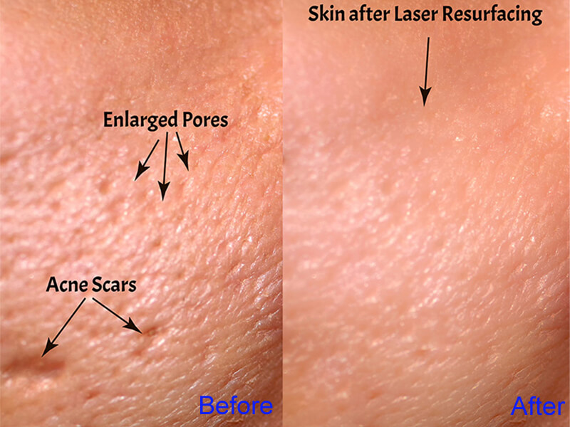 co2 fractional laser before and after