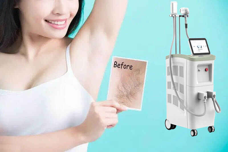 professional diode laser hair removal machine