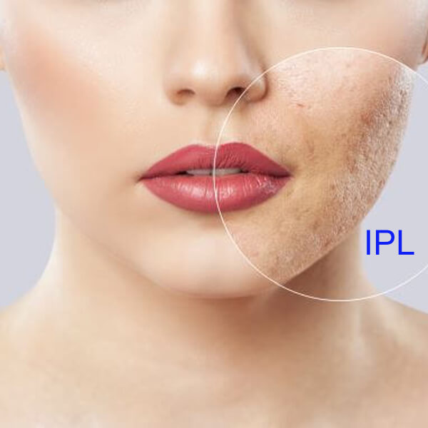La mejor máquina IPL profesional para el rejuvenecimiento de la piel