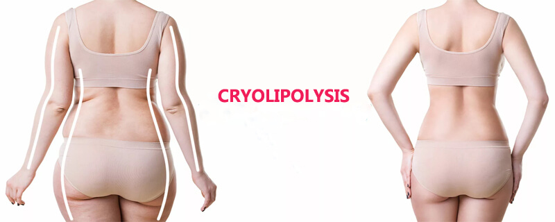 cryolipolysis slim treatment