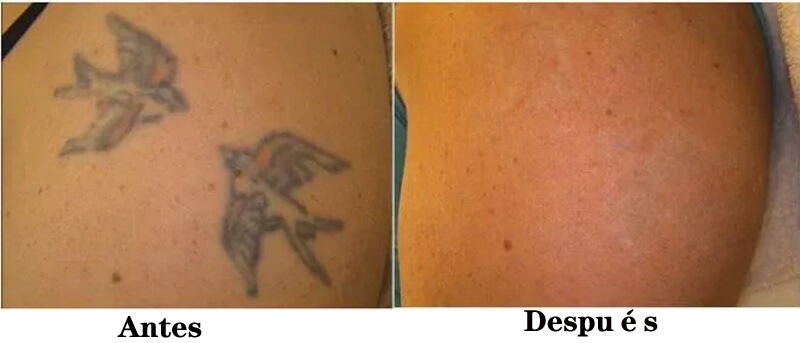 nd yag q switch laser para eliminar tatuaje