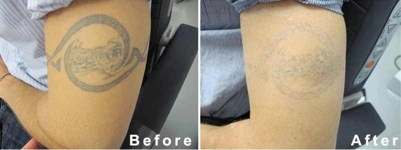 laser tattoo removal machine treatment