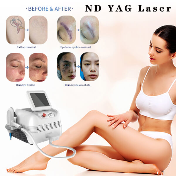 El porcentaje de éxito del tratamiento de eliminacion de tatuajes con laser ND YAG