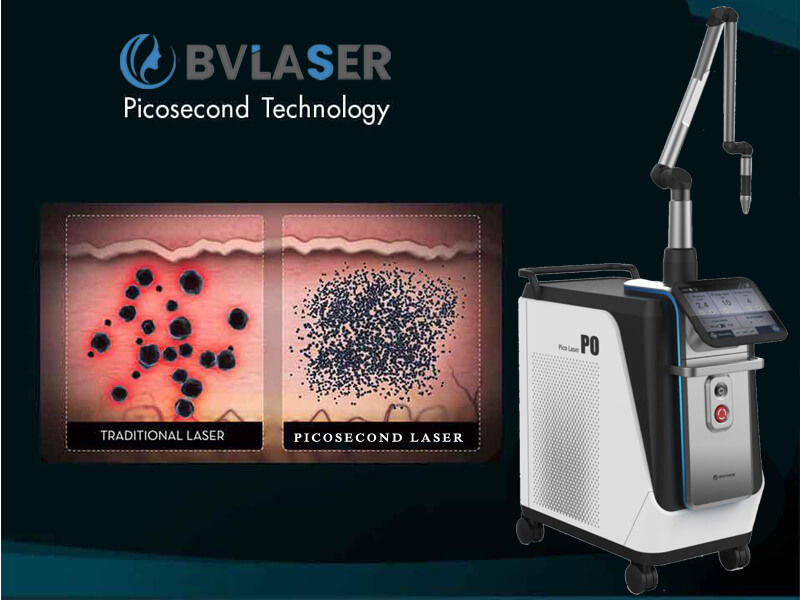picosecond laser tattoo removal machine