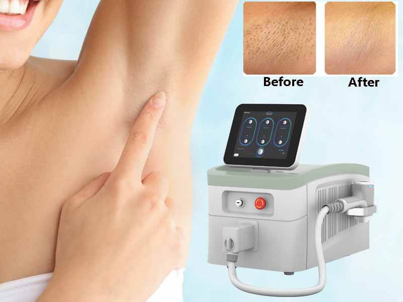 best professional laser hair removal machine