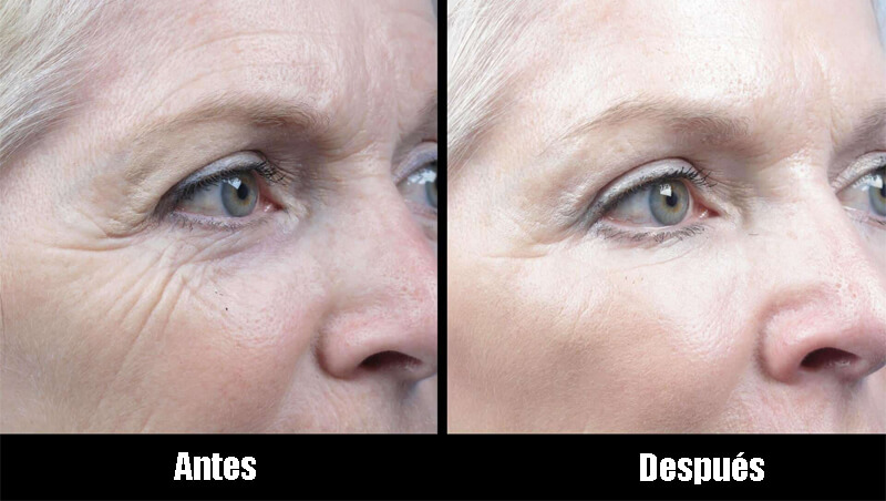 erbium glass laser treatment before and after