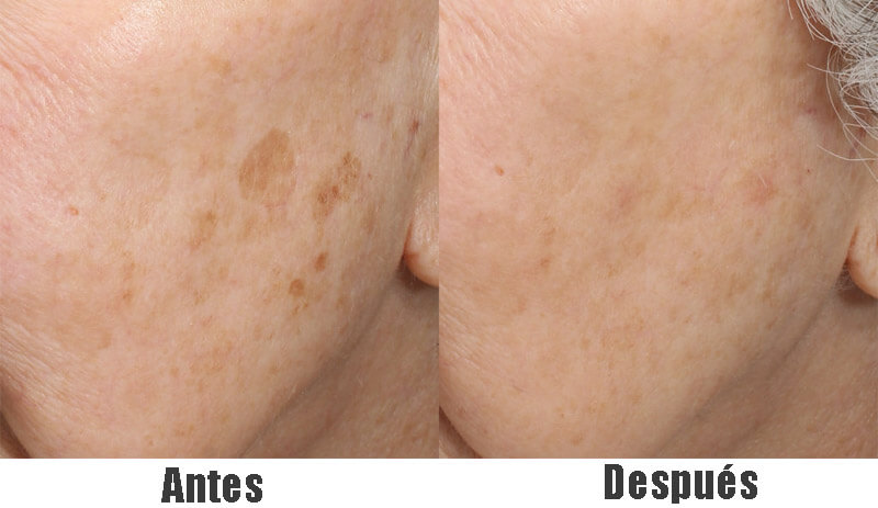 nd yag laser treatment before and after