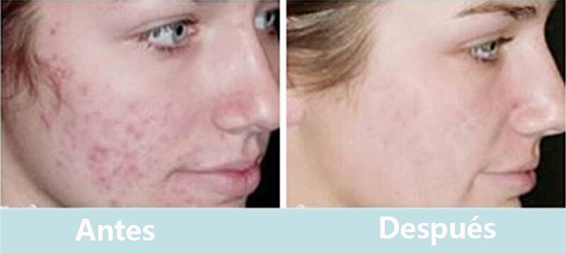 co2 fractional laser treatment before and after