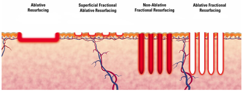 co2 fractional laser treatment