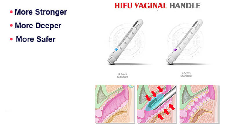 hifu vaginal