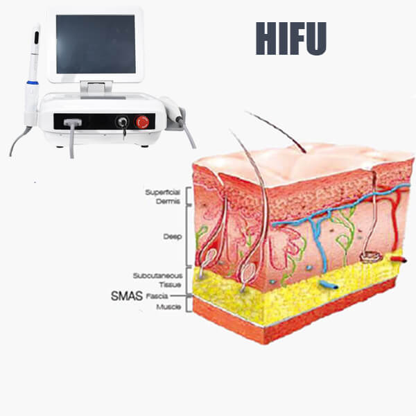 ¿Quién puede recibir tratamiento HIFU y qué áreas se puede tratar HIFU?