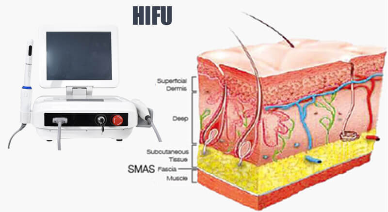 hifu skin tightening machine