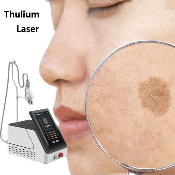 Láser de tulio en el tratamiento de la pigmentación: un enfoque innovador en dermatología