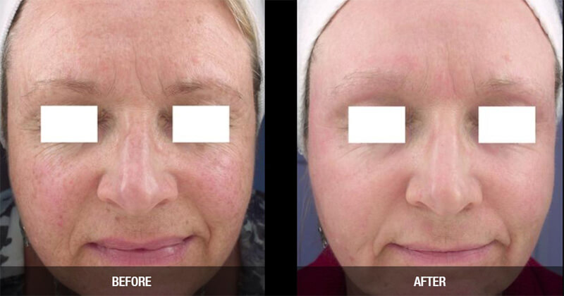 co2 fractional laser treatment before and after