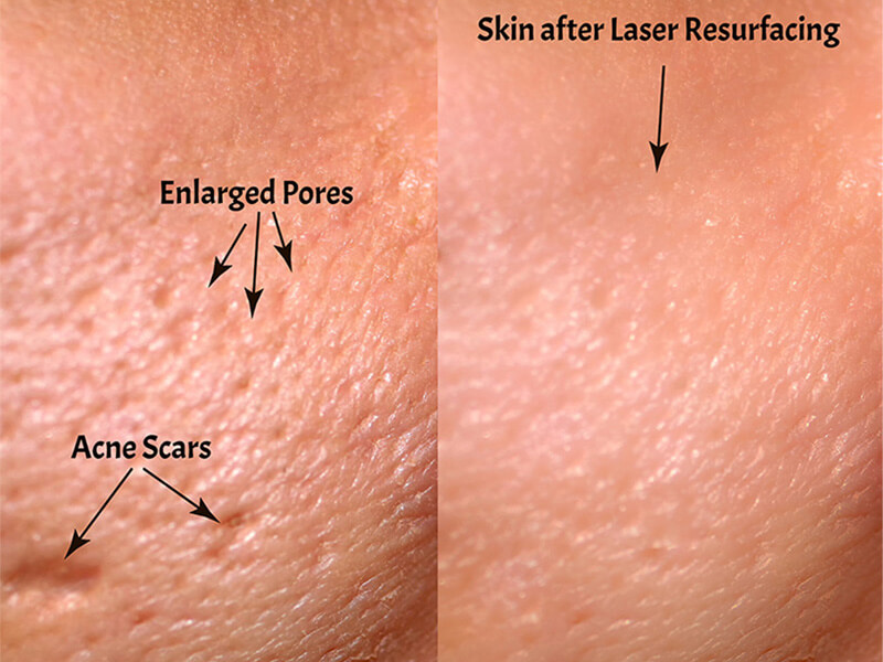 co2 laser skin resurfacing