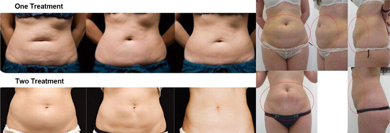 cryolipolysis fat freezing