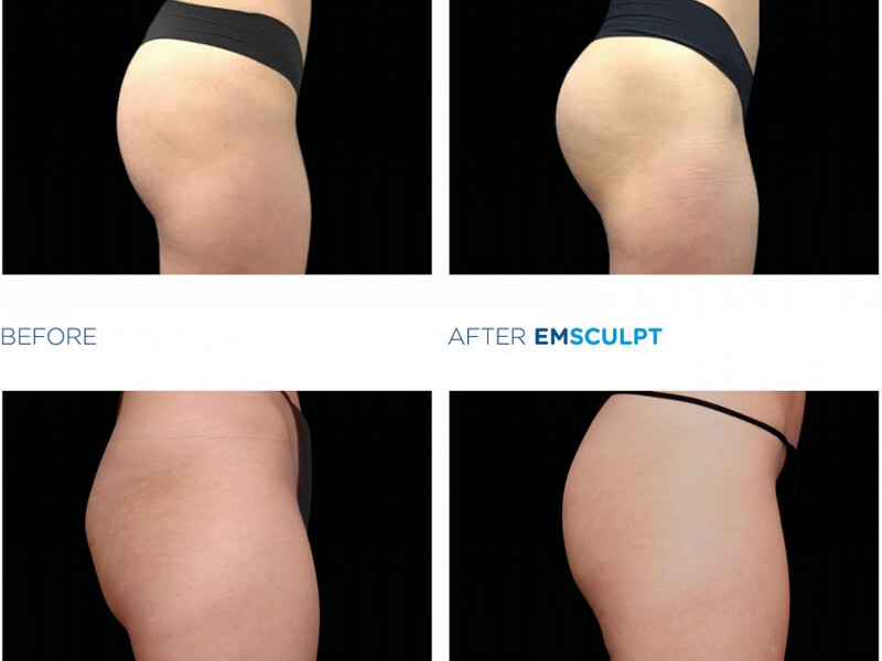 emsculpt treatment