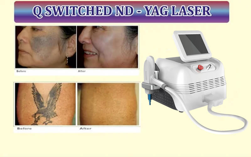 q-switched nd yag laser machine