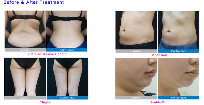 cryolipolysis treatment before and after
