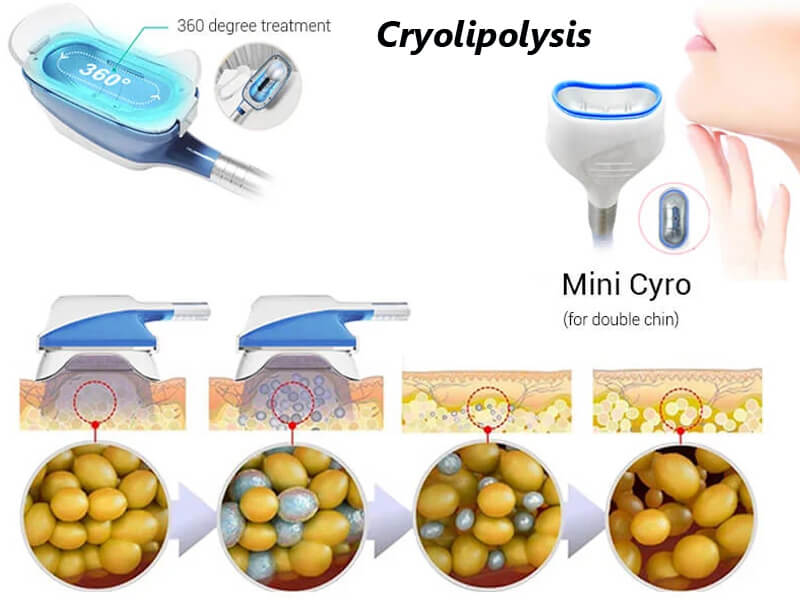 cryolipolysis treatment