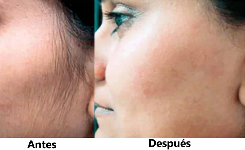 diode laser hair removal treatment before and after