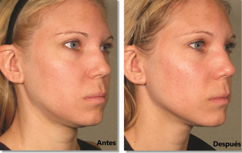 hifu treatment before and after