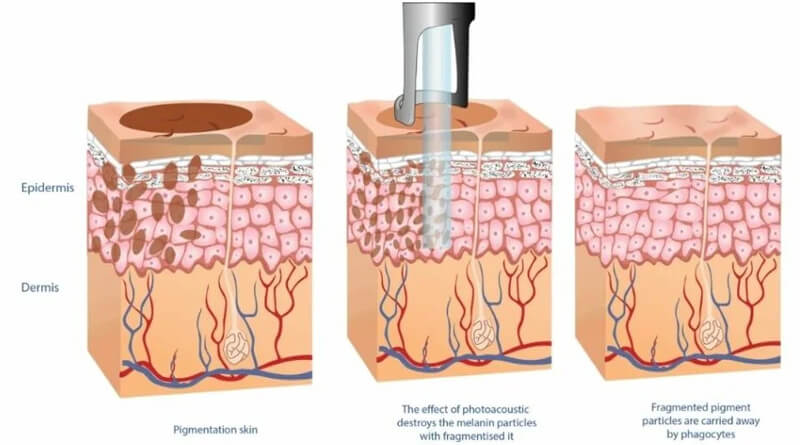 picosecond laser treatment