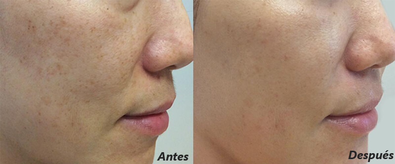 picosecond laser treatment before and after