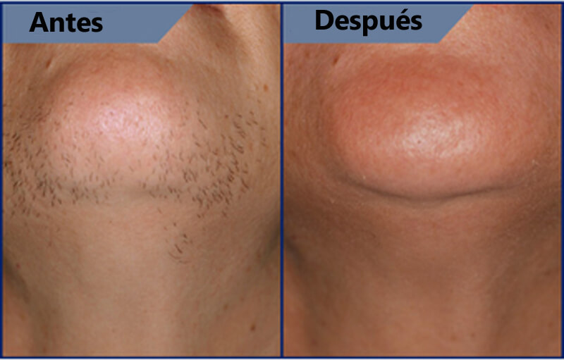 laser hair removal treatment before and after