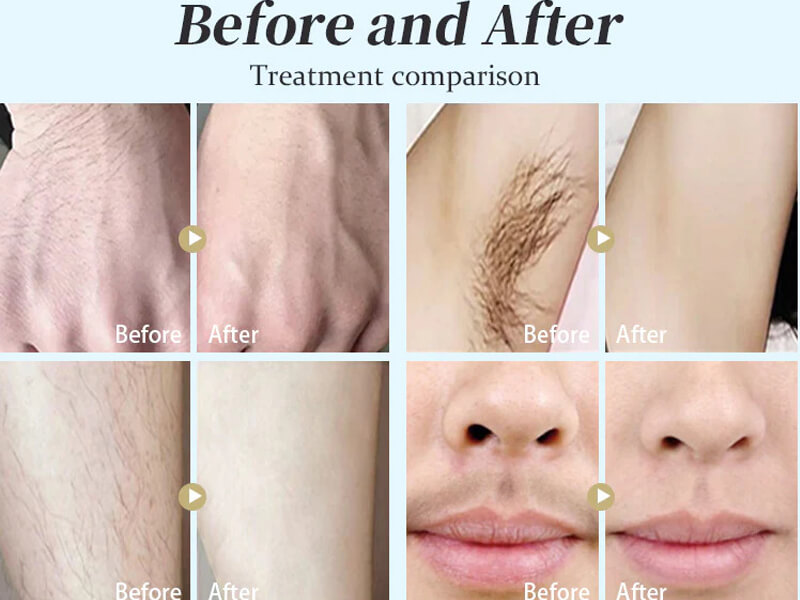 laser hair removal treatment before and after