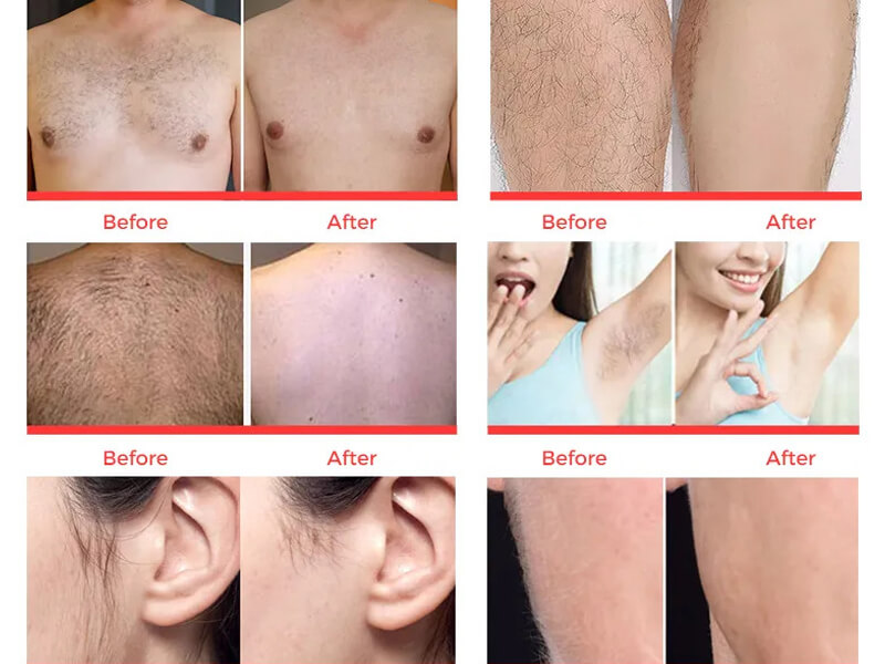 laser hair removal treatment before and after