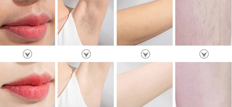 laser hair removal treatment before and after