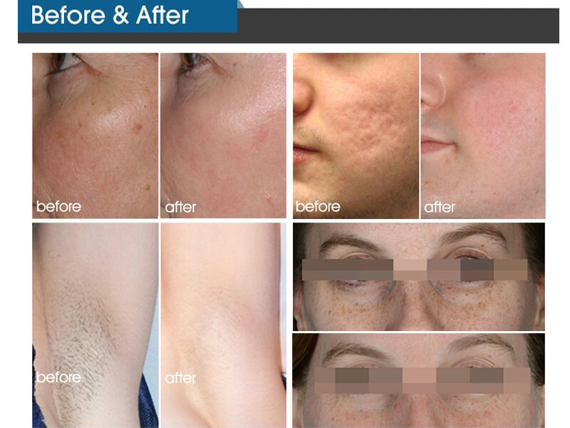 ipl laser treatment before and after