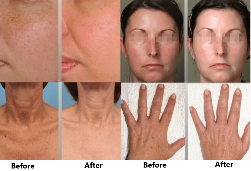 ipl skin rejuvenation treatmment