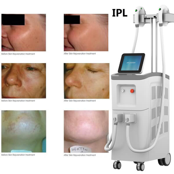 ¿Qué condiciones de la piel aborda el tratamiento IPL?