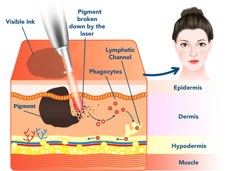 ND YAG laser treatment