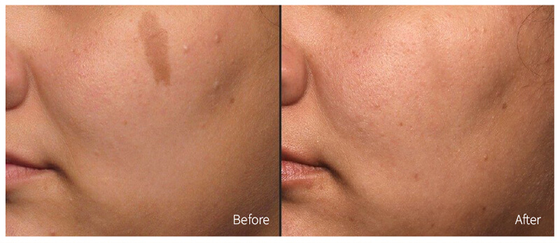 nd yag laser treatment before and after