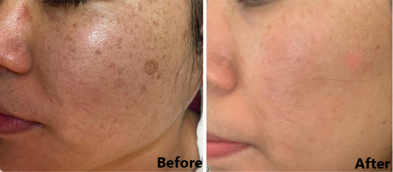 nd yag laser treatment before and after