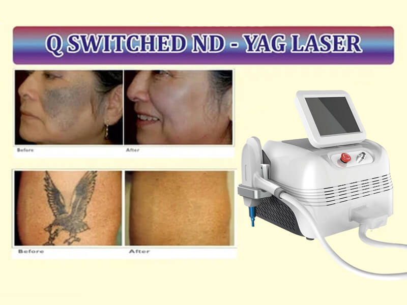 nd yag laser machine